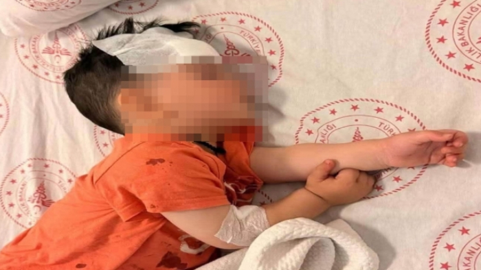 Halfeti'de Sokak Köpeği Dehşeti: 1,5 Yaşındaki Muhammed Ali'nin Yüzüne 6 Dikiş Atıldı